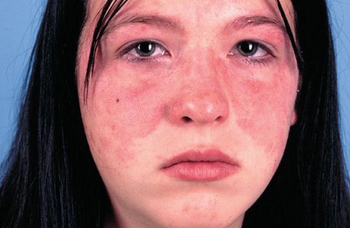 bệnh lupus ban đỏ gây ngứa và mất thẩm mỹ