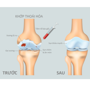 Mối tương quan giữa thoái hóa khớp gối và thừa cân, béo phì