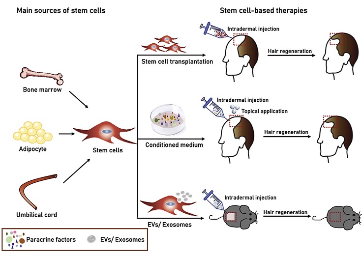Các liệu pháp dựa trên tế bào gốc, đặc biệt là các liệu pháp dựa trên môi trường nuôi cấy có nguồn gốc từ tế bào gốc (CM), được tiết ra bởi tế bào gốc và giàu các yếu tố cận tiết, đã được khám phá rộng rãi như một loại thuốc tái tạo tóc [7].