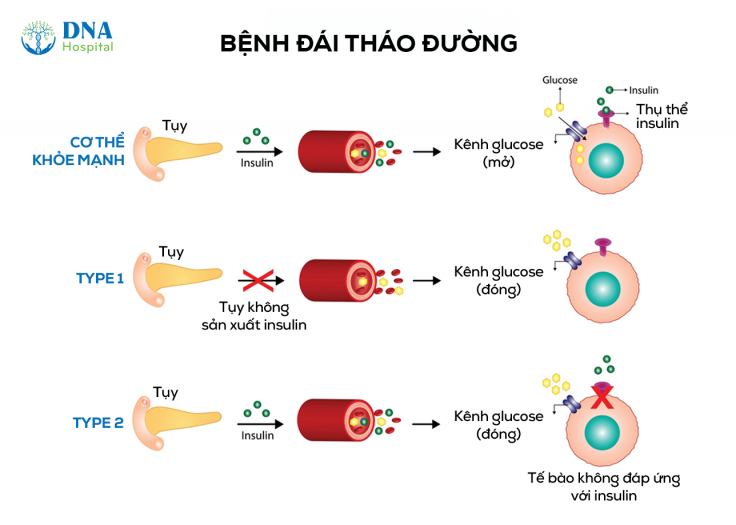 te-bao-goc-trong-dieu-tri-tieu-duong-tuyp-1(1)